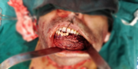 Jaw Bone Cancer Treatment in Hyderabad